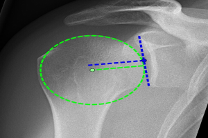 Ein Röntgenbild einer Schulter mit einem grünen Kreis, der die Lage eines Bandes markiert, umgeben von anderen Bändern.